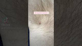 Skin Tag Removal before and after results skintagremoval [upl. by Atikel601]