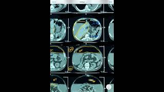 CHALLENGING CT ABDOMEN SPLENIC INFARCTIONPNEUMOPERITONEUMASCITIS [upl. by Livy]