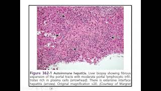 Pediatric Hepatology Cases  Discussion [upl. by Nnazil]