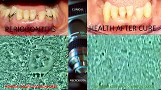 Periodontitis Microbiota Vs Health Microbiota An Evidence [upl. by Manfred176]