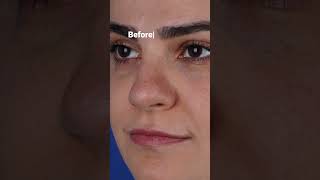 Rhinoplasty  Deviated Nose rhinoplastybeforeafter nosesurgery deviatednose [upl. by Ahens]