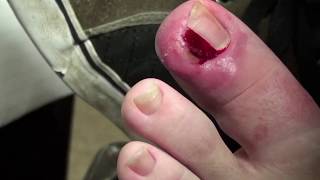 Santa Barbara Podiatrist foot doctor talks about Ingrown Toenails [upl. by Bright560]