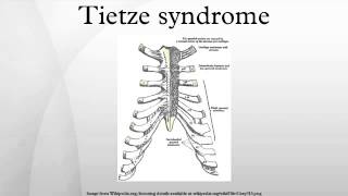 Tietze syndrome [upl. by Boony6]