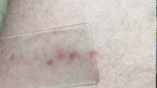 Glass test  Meningitis rash [upl. by Ayokal]