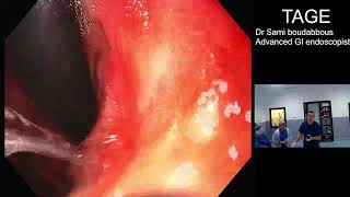 Gastroscopy for a gastric cancer after chemotherapy [upl. by Eiknarf320]