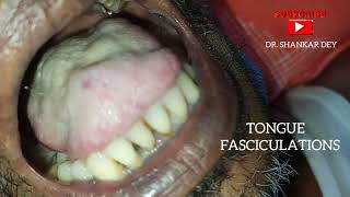 Tongue Fasciculations  Motor Neuron Disease  Amyotrophic Lateral Sclerosis  Dr Shankar Dey [upl. by Gobert]