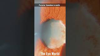 posterior Synechiae in uveitis [upl. by Akirdnwahs]