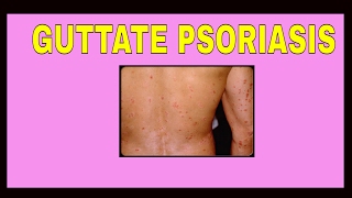 Guttate Psoriasis  Symptoms  Treatments  Causes  Pictures  Type [upl. by Arutnev]