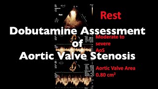 Dobutamine Assessment of Aortic Valve Stenosis [upl. by Nira]