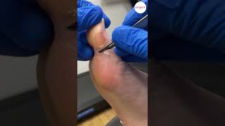 big toe thick callus [upl. by Anitsud391]