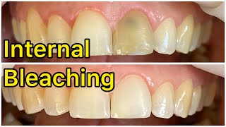 30 years old female  tooth discoloration  internal bleaching  Dr Sara  dentist  Bleaching [upl. by Erdnael45]