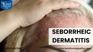 Seborrheic dermatitis सेबोरिक डर्मटाइटिस [upl. by Anna-Diana259]