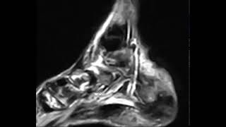 The double line sign is a pathognomonic MRI for [upl. by Tor]