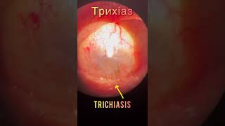 Corneal opacification and trichiasis  Помутніня рогівки і трихіаз  Помутнение роговицы и трихиаз [upl. by Cohl]