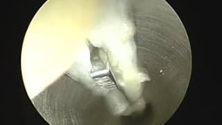 Endoscopic Plantar Fasciotomy SFISM [upl. by Ahsitram]