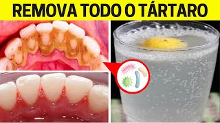 Basta Só Isto Nos DENTES Para REMOVER O TÁRTARO Sem Gastar Quase Nada [upl. by Nnaylime603]