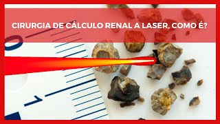 Cirurgia de Cálculo Renal a Laser Como É [upl. by Whitten]