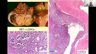 CLASIFICACIÓN PATOLÓGICA DEL CÁNCER DE OVARIO PROF XAVIER MATÍAS GUIU [upl. by Oriole]