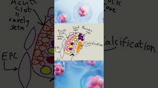 Is atherosclerosis reversible new version [upl. by Quincey]