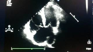 Echocardiogram  ostium primum atrial septal defect [upl. by Poucher]