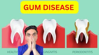 Gingivitis Vs Periodontitis Watch This Before It is TOO LATE [upl. by Afital]