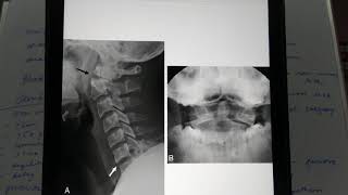 C2 odontoid fractures [upl. by Amie]