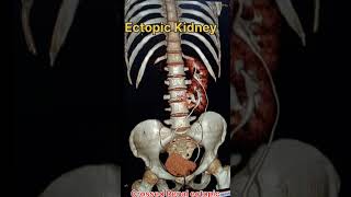 ectopic kidney ct scan medicalimaging shortvideo [upl. by Prudy]