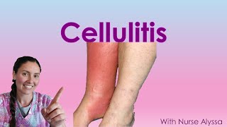 Cellulitis [upl. by Yusem]