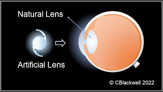 Intraocular Lenses 2 Vision After Surgery [upl. by Akiram686]