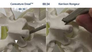 Decompression using Dreal® vs Kerrison Ronguers [upl. by Atikahc]