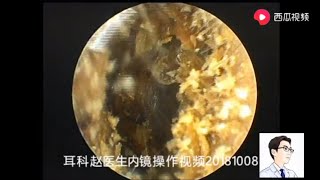 Ear wax removal Bilateral external auditory canal cholesteatoma 8 minutes 双侧外耳道胆脂瘤，8分钟 [upl. by Cobbie356]