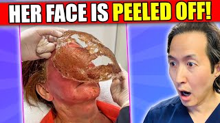 Plastic Surgeon Reacts to Face Peeling Off Videos phenol peel [upl. by Nilauqcaj]