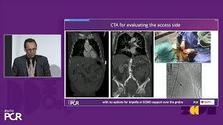 The complexity in treatment of patients in shock  EuroPCR 2024 [upl. by Lamok]