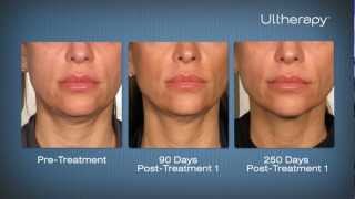 Ultherapy Before amp After Pictures at Laser Clinique in San Diego [upl. by Nahgem]