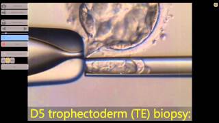 Hatching blastocyst biopsy [upl. by Hayse]