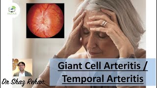 Giant Cell Arteritis GCA  Temporal Arteritis  All You Need to Know I Dr Shaz Rehan 2022 [upl. by Benson]