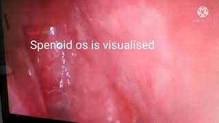 MEDIAL APOROACH TO SPHENOID SINUS  ISOLATED SPHENOID SINUSITIS RIGHT SIDE [upl. by Stalk]