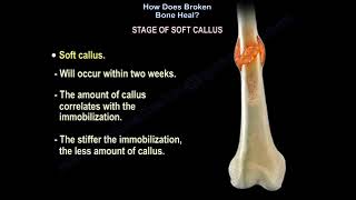 Fracture Healing Part 1  Everything You Need To Know  Dr Nabil Ebraheim [upl. by Som]