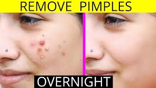 How To Remove Pimples Overnight  Acne Treatment  Anaysa [upl. by Leidag]