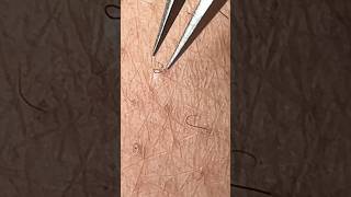 evict INGROWN HAIRS in 2 Steps ingrownhair sugarwax hairremoval [upl. by Lisan]