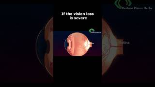 Treatment of Optic Neuritis [upl. by Pillsbury]