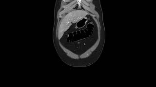 How to read a CT of the Abdomen and Pelvis  a quick practical approach coronal [upl. by Anialram]