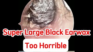 Too Horrible Super Large Black Earwax Blocks Ear Holes  EP 048 [upl. by Aicel]