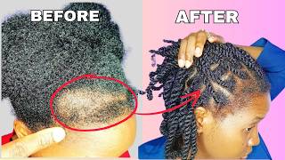 She Grew Back Her Receding Hairline In 10 Days  Bald Spots And Bald Edges Gone With One Product [upl. by Aleihs]