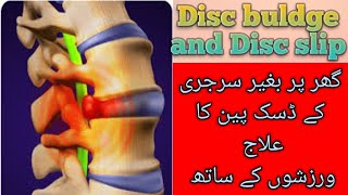 Backpain treatment by dr warda  S6  Exercises for disc pain  UrduHindi [upl. by Woodcock73]