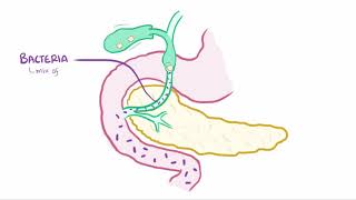 Ascending cholangitis acute cholangitis causes symptoms diagnosis amp pathology [upl. by Eidoj]