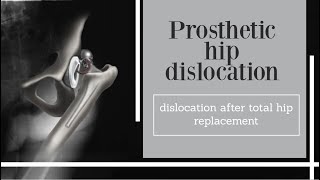 Prosthetic hip dislocation dislocation after total hip replacement [upl. by Helbonia]