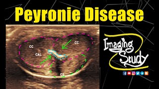 Peyronie Disease  Ultrasound  Case 238 [upl. by Zeiler183]