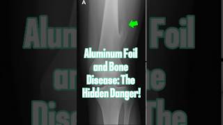 Aluminum Foil and Bone Disease The Hidden Danger [upl. by Saber]