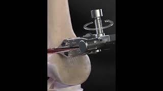 Distal Femoral Osteotomy  animationshorts shortsfeed youtubeshorts viralshorts [upl. by Dustie]